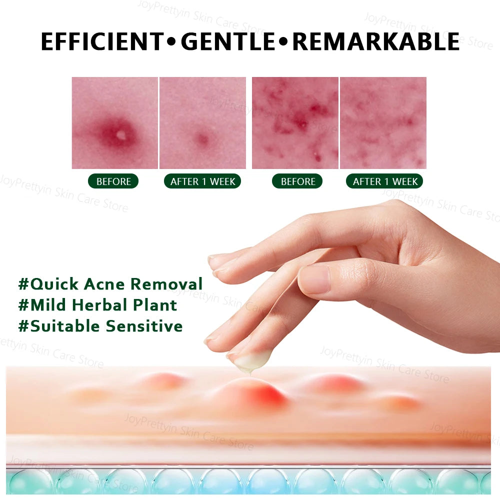 ClearGlow Herbal Acne Cream