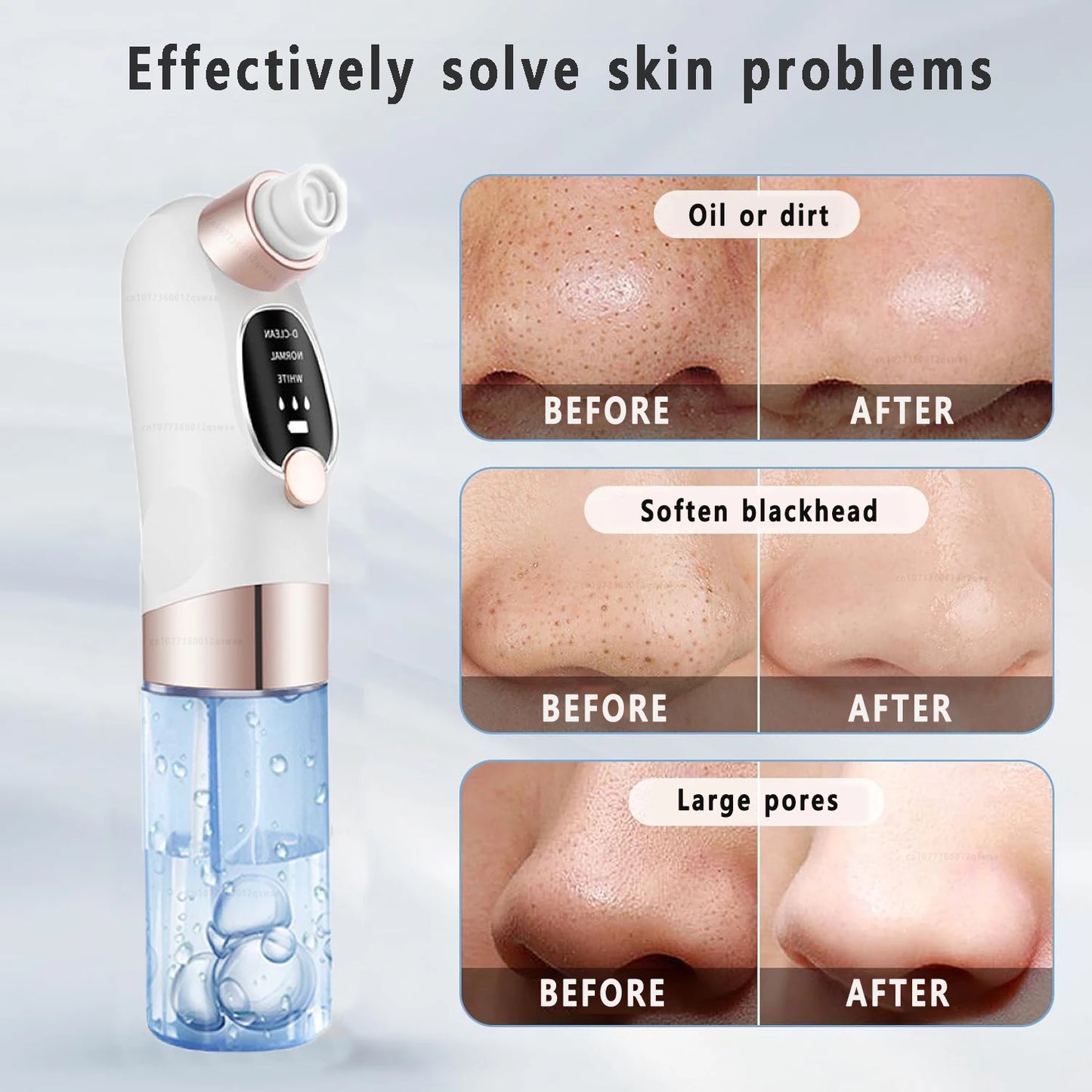 Blackhead Removal
