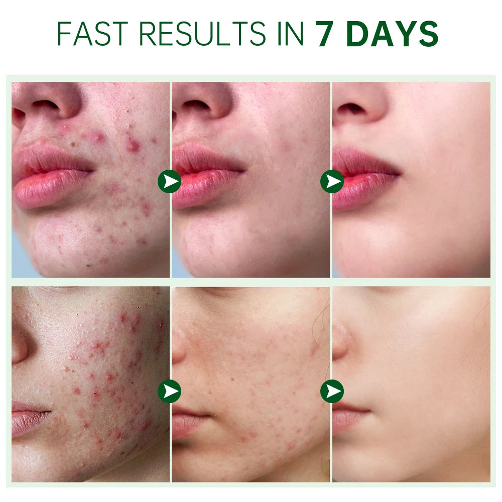 ClearGlow Herbal Acne Cream