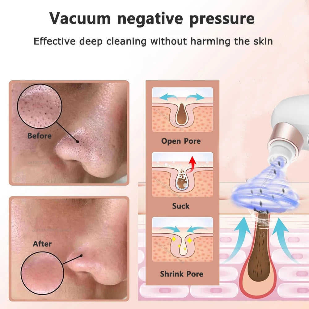Blackhead Removal